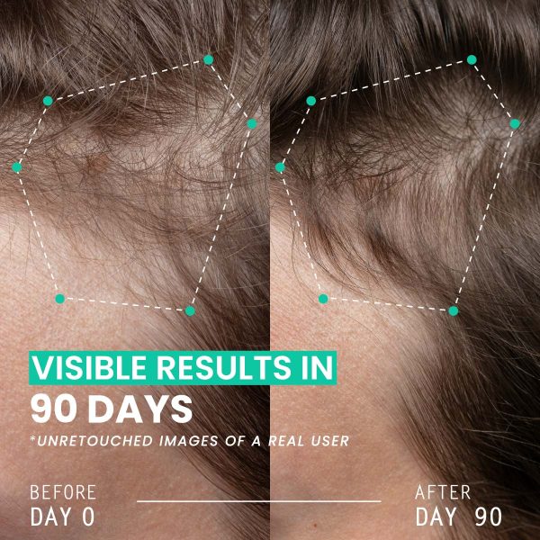 Hair Thickening Dual Action Routine - 90 Day Anti Hair Loss Solution - 3 Month Intensive Programme - Image 2