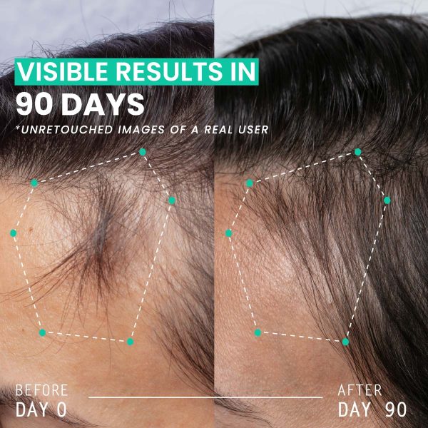 Hair Thickening Dual Action Routine - 90 Day Anti Hair Loss Solution - 3 Month Intensive Programme - Image 3