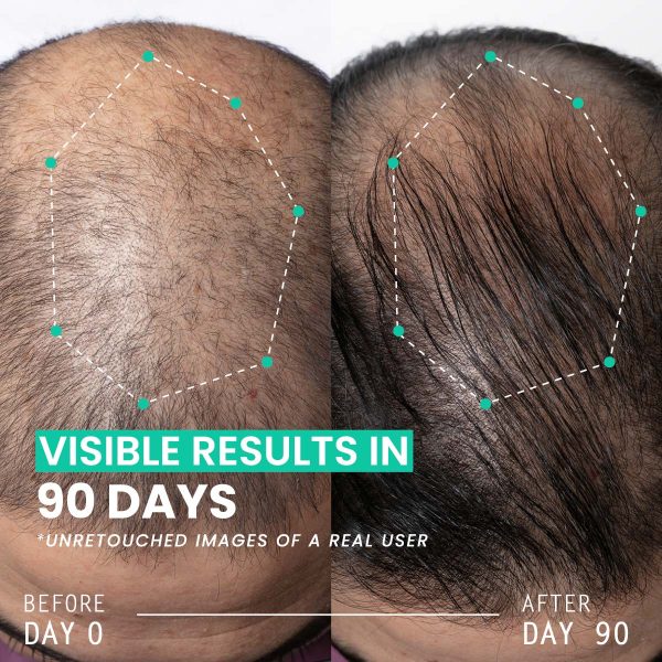 Hair Thickening Dual Action Routine - 90 Day Anti Hair Loss Solution - 3 Month Intensive Programme - Image 4